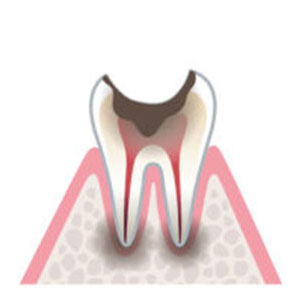 C4歯の根(歯質)が失われた歯