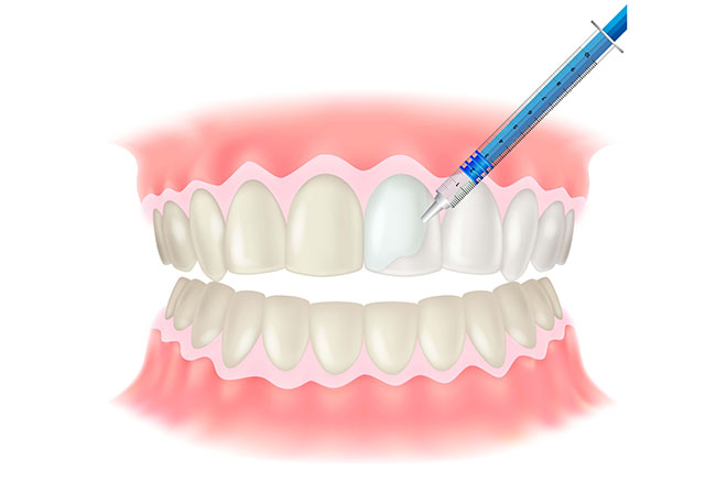 オフィスホワイトニング