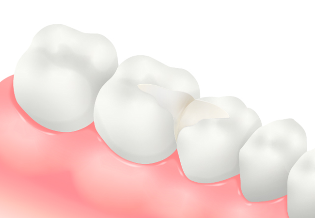 メタルインレー