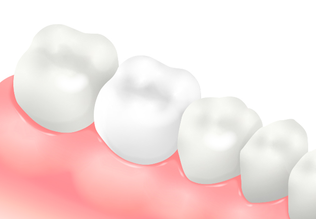 フルジルコニアインレー　フルジルコニアクラウン