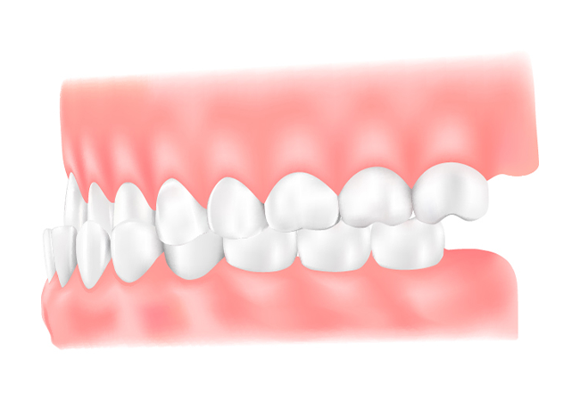 受け口(下顎前突：かがくぜんとつ)