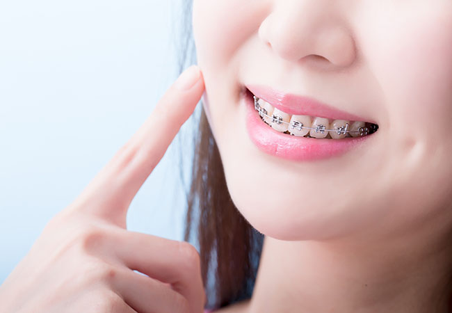 金属ブラケット