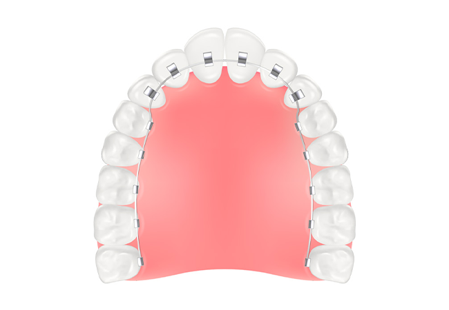 リンガルブラケット