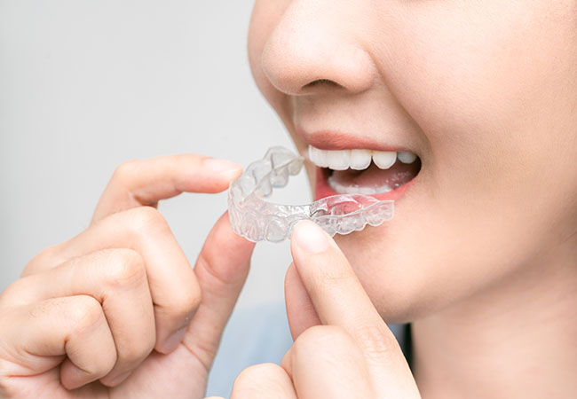 マウスピース矯正