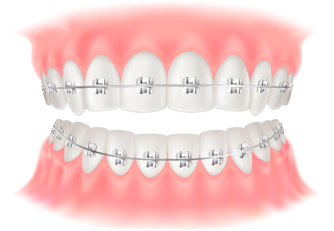 表側（ラビアル）矯正