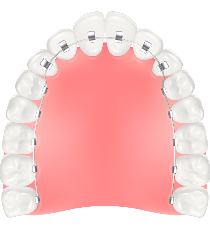 裏側（リンガル）矯正