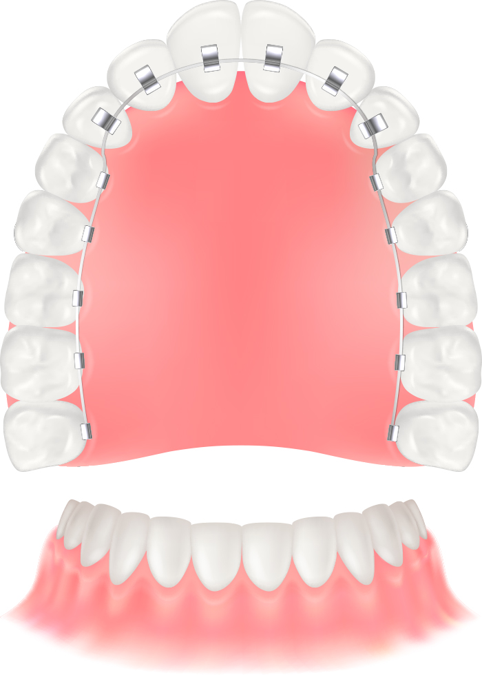 ハーフリンガル矯正