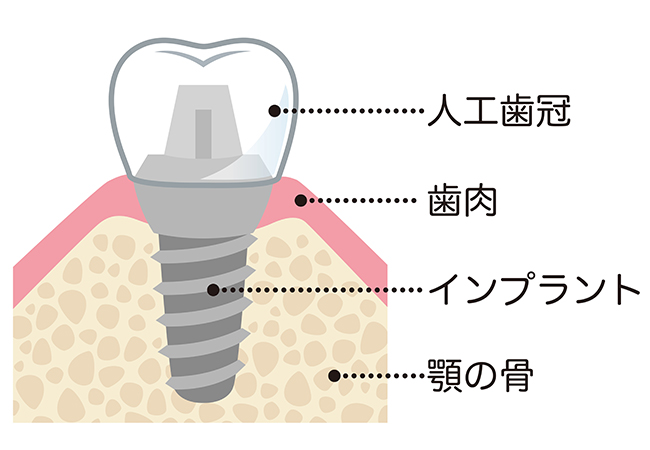 インプラント