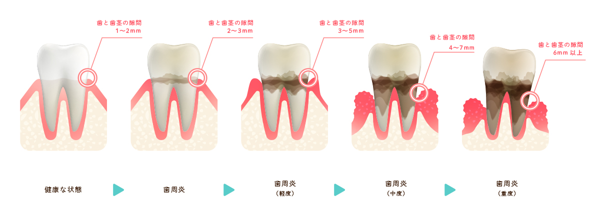歯周病の進行段階