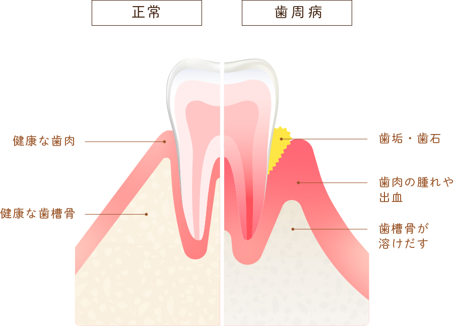 健康な歯と歯周病の歯