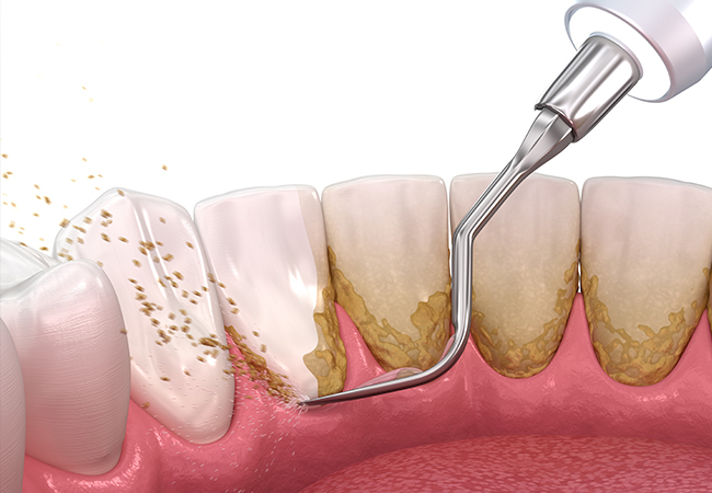 スケーリング(歯石取り)