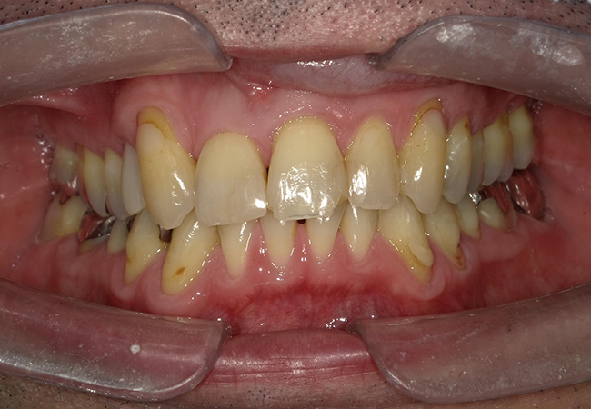 ジルコニアセラミックス 症例1 正面 Before