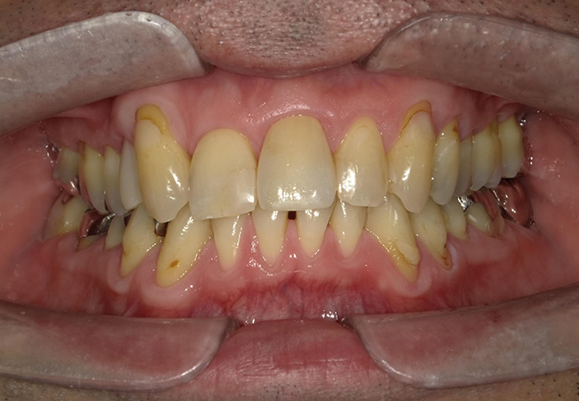 ジルコニアセラミックス 症例1 正面 after