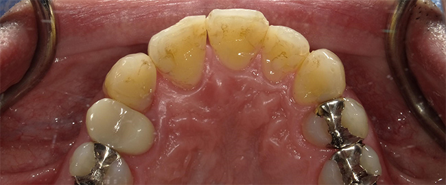 ジルコニアセラミックス 症例1 裏側 Before