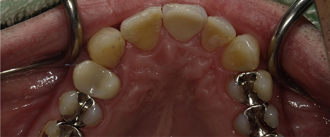 ジルコニアセラミックス 症例1 裏側 after
