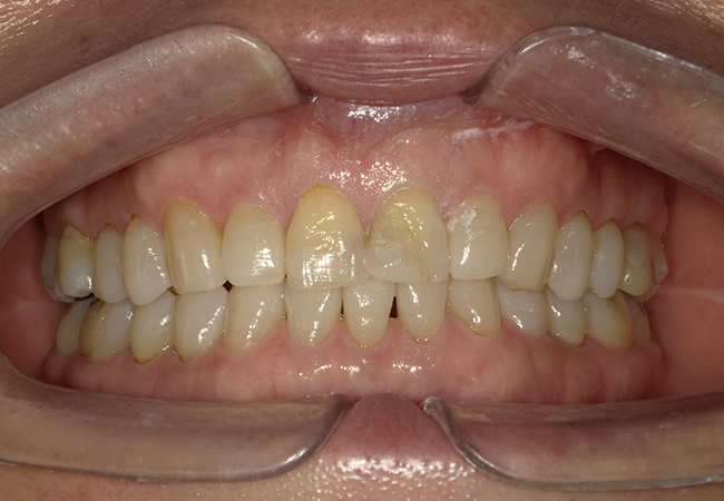 ジルコニアセラミックス ホームホワイトニング 症例2 正面 Before