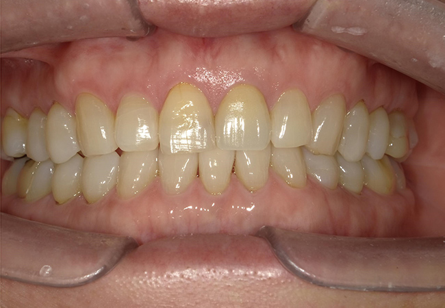 ジルコニアセラミックス ホームホワイトニング 症例2 正面 after