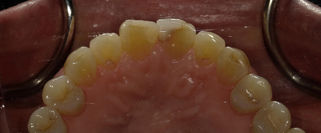 ジルコニアセラミックス ホームホワイトニング 症例2 裏側 Before