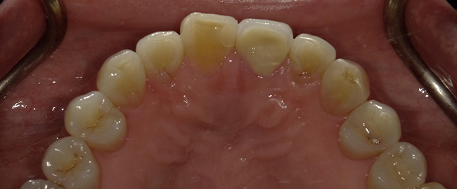 ジルコニアセラミックス ホームホワイトニング 症例2 裏側 after