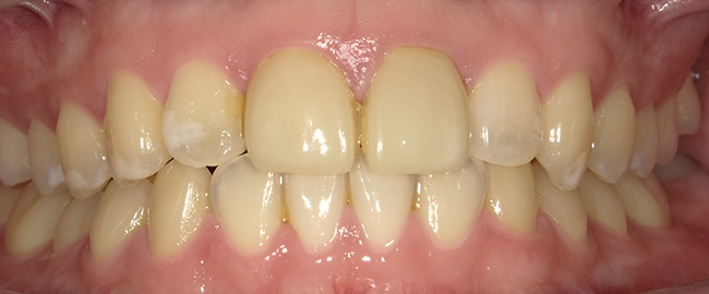 ジルコニアセラミックス ホームホワイトニング 症例3 正面 before