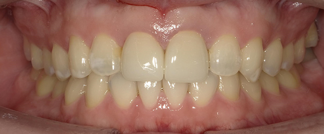 ジルコニアセラミックス ホームホワイトニング 症例3 正面 after