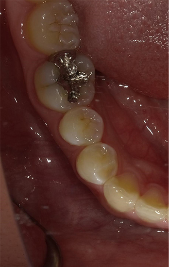 セラミックインレー 症例4 before