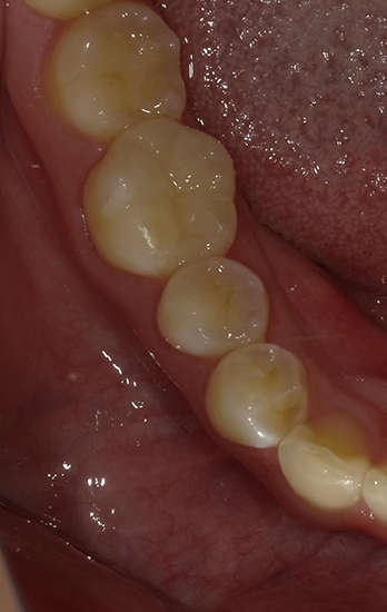 セラミックインレー 症例4 after