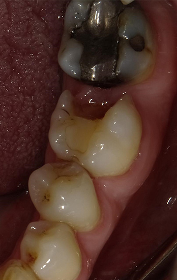 ジルコニアインレー 症例5 before