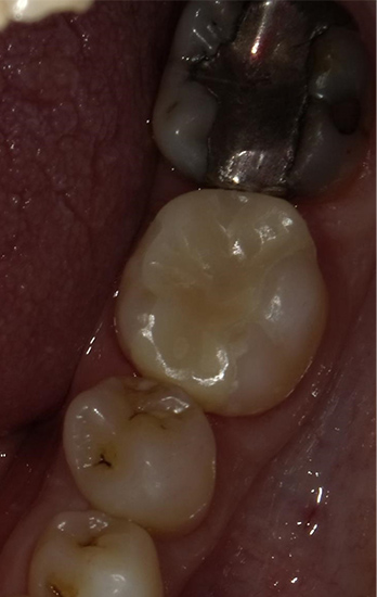 ジルコニアインレー 症例5 after