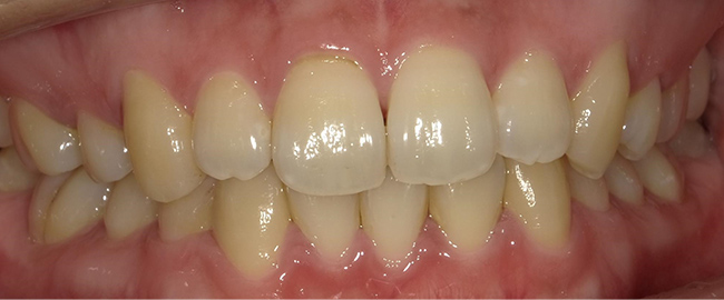 ホームホワイトニング 症例6 before