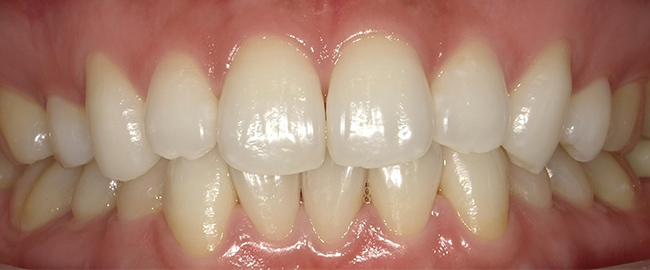 ホームホワイトニング 症例6 after